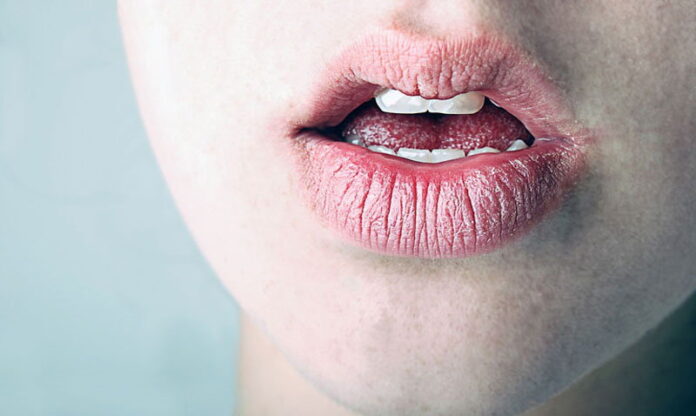 Как избавиться от шелушащихся и потрескавшихся губ